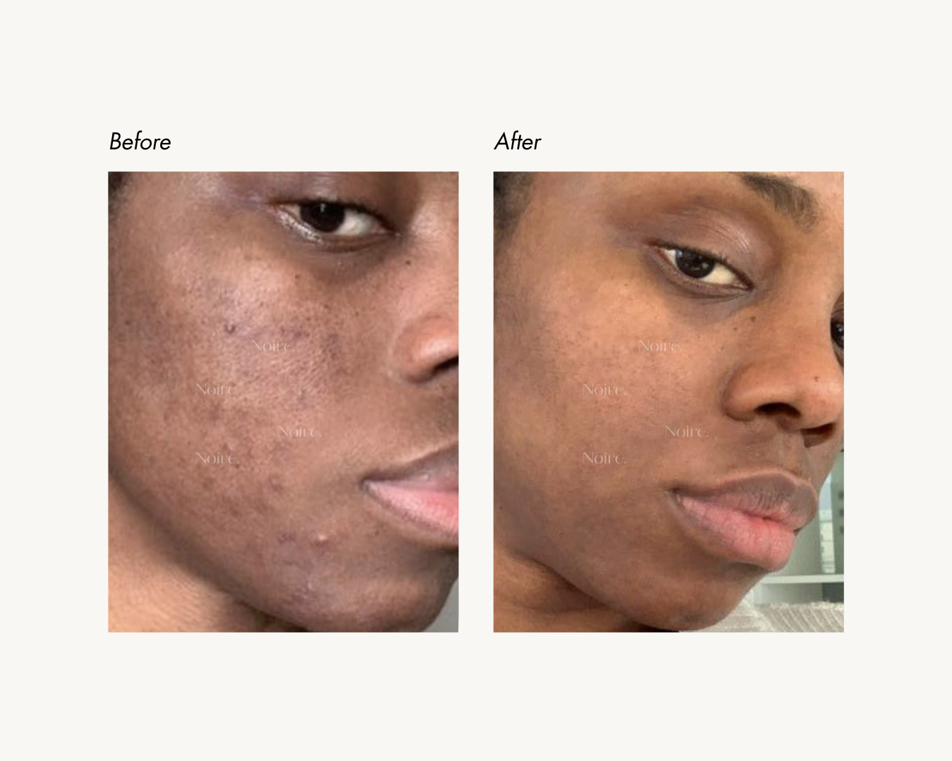 MOOYAM ACNE FACE CREAM